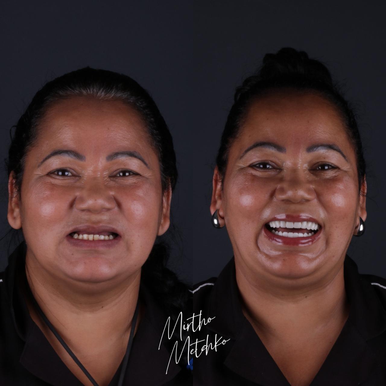 Transformação completa com implantes dentários Caso de sucesso implantes - Antes e depois mulher