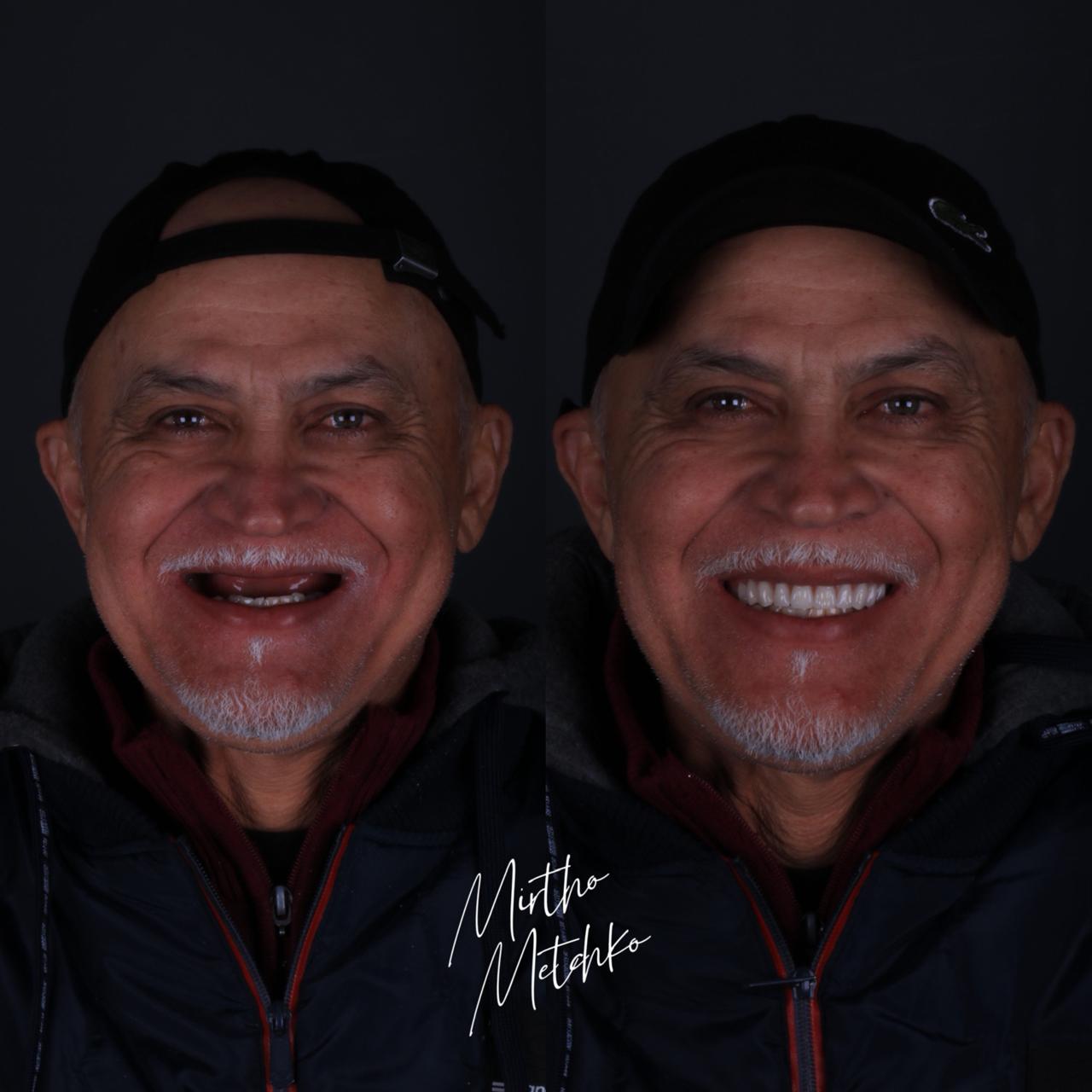 Reabilitação oral com implantes de titânio Caso de sucesso implantes - Antes e depois homem