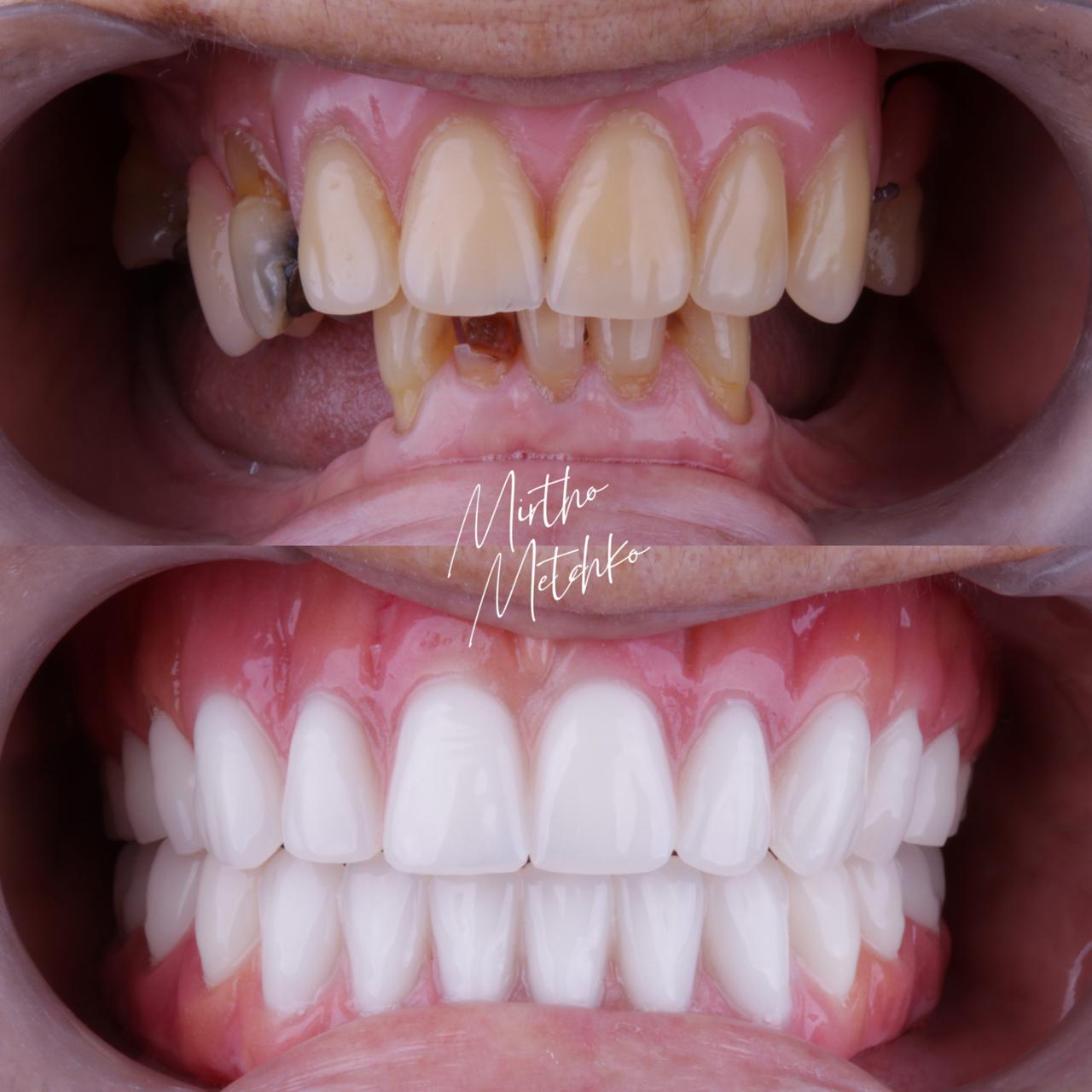 Transformação dental com implantes e coroas Caso de sucesso implantes - Antes e depois boca